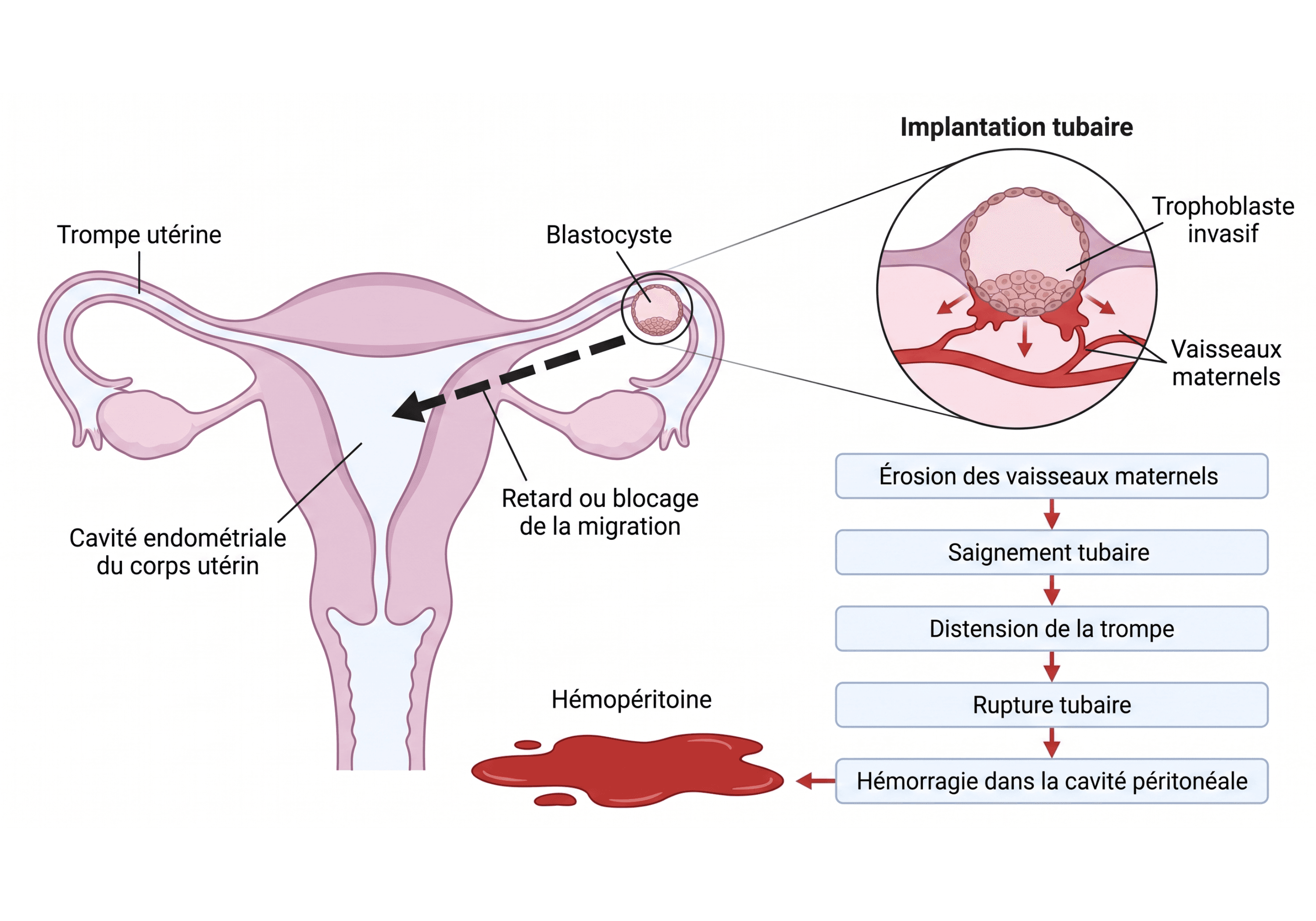 De l'implantation tubaire à l'hémopéritoine