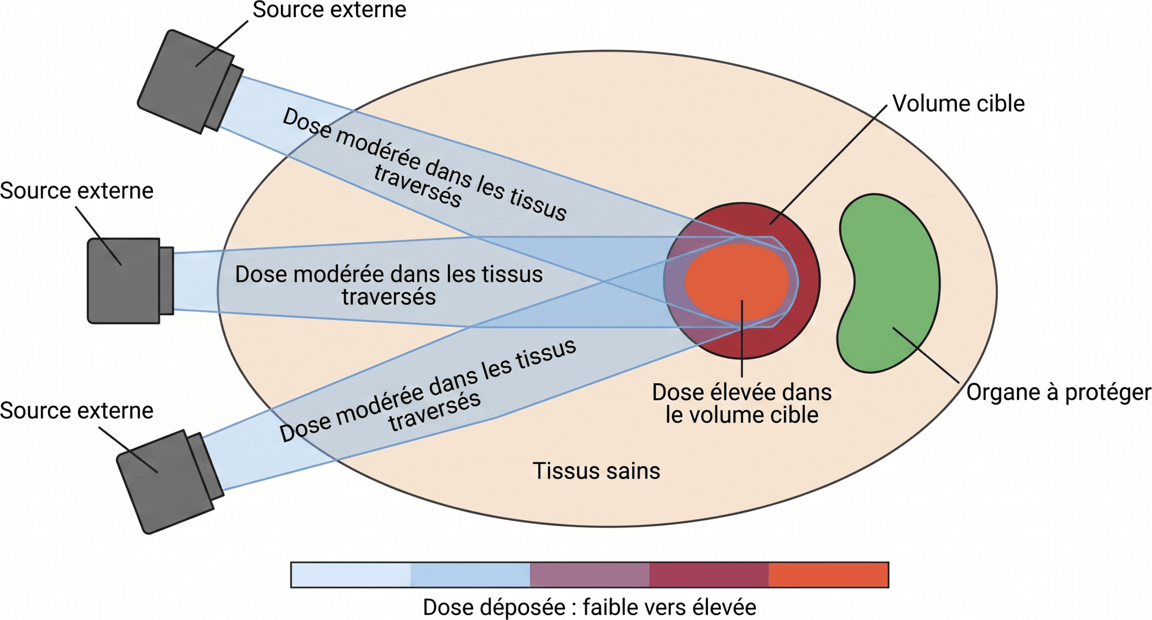 Convergence de faisceaux en irradiation externe