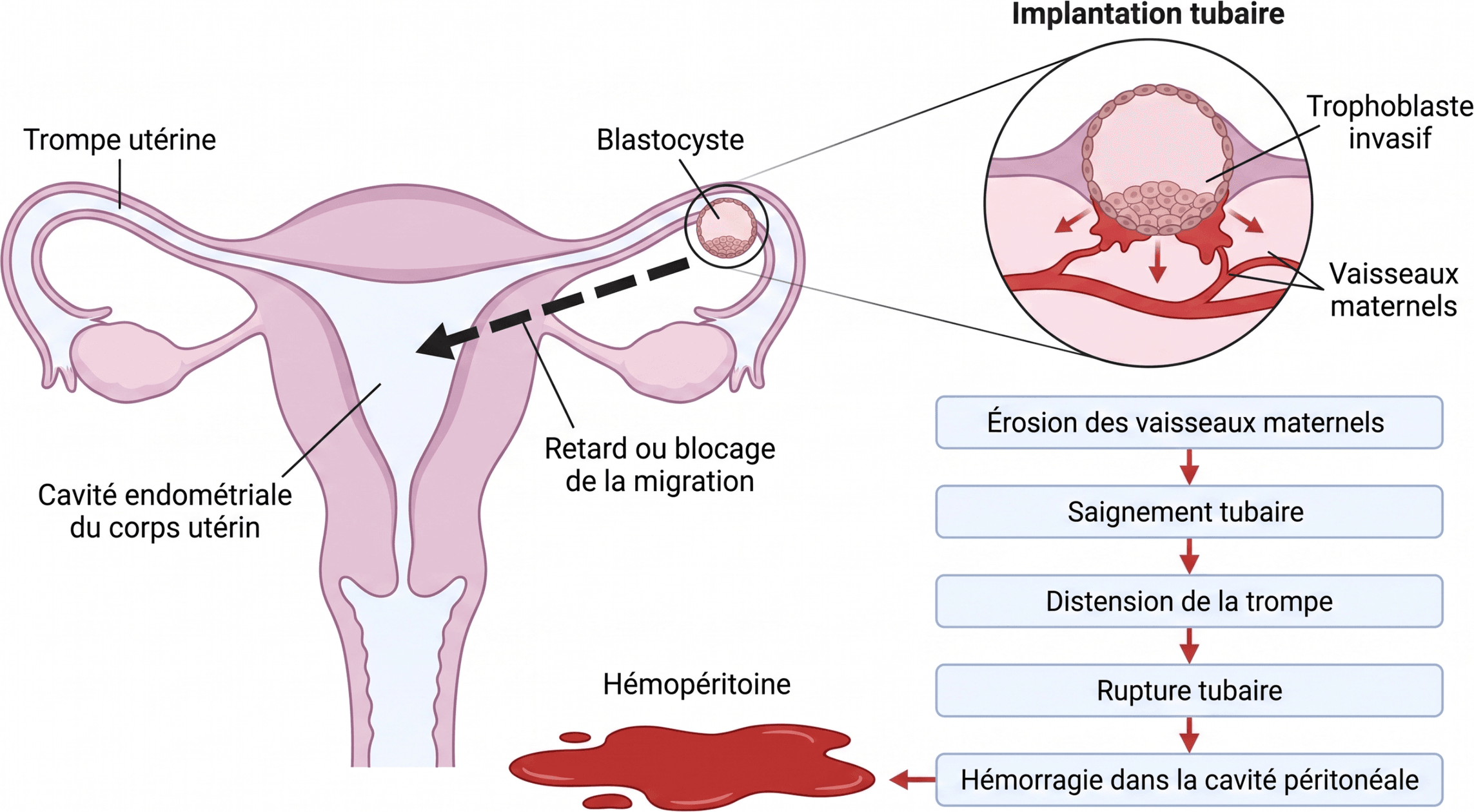 De l'implantation tubaire à l'hémopéritoine