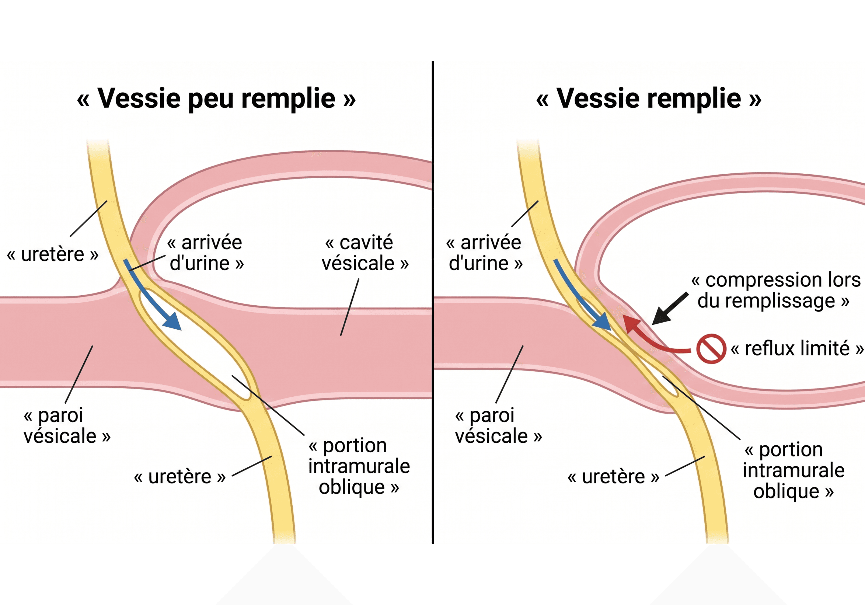 Mécanisme anti-reflux de la portion intramurale de l'uretère